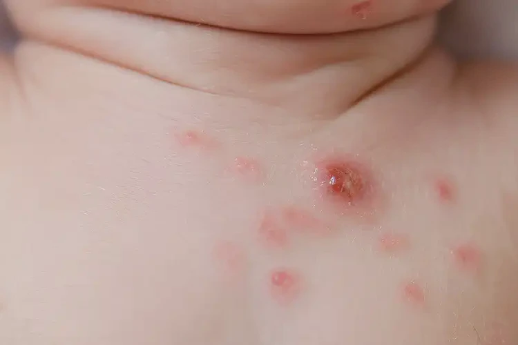 新生兒脖子長(zhǎng)濕疹能夠徹底治愈嗎(圖4)