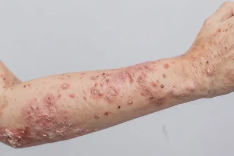 女生手臂上出現(xiàn)濕疹可以徹底自愈嗎(圖3)