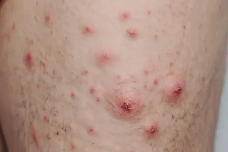 男生大腿容易長(zhǎng)濕疹不管它會(huì)自己自愈嗎(圖4)