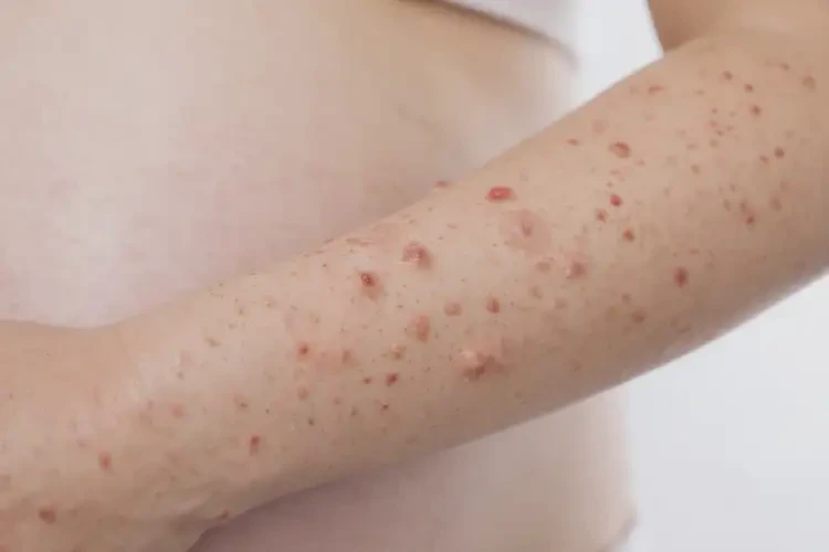 孕婦手臂長濕疹能夠徹底治愈嗎(圖4)