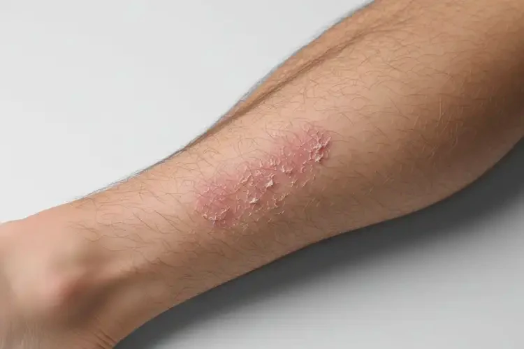 男人小腿上出濕疹不管它會自己痊愈嗎(圖2)