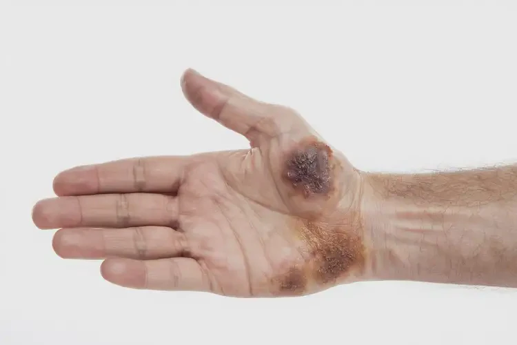 男人手上出濕疹能自愈嗎(圖2)