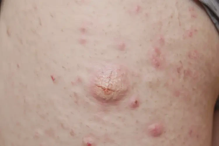 產(chǎn)婦大腿容易起濕疹能夠徹底治愈嗎(圖4)