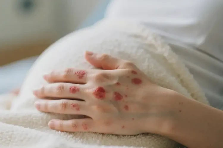 孕婦手上長(zhǎng)濕疹能徹底自愈嗎(圖4)