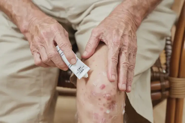 老人大腿上出濕疹不管它會自己痊愈嗎(圖2)