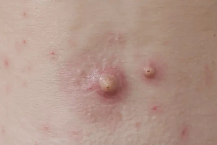 女性肛周出濕疹能夠徹底治愈嗎(圖4)