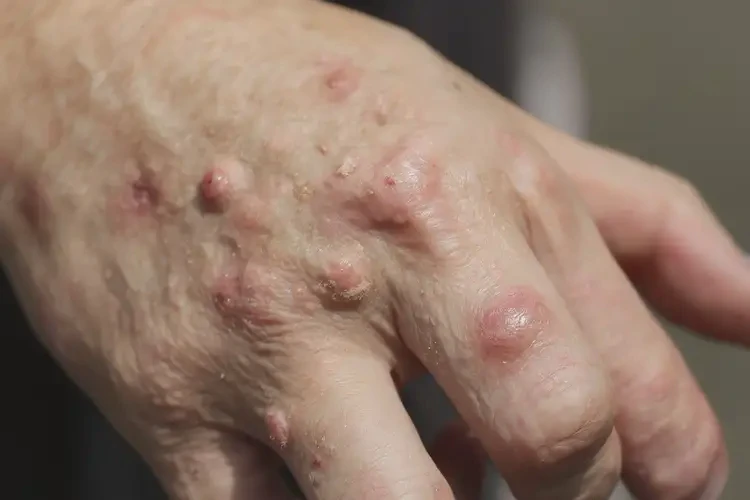 男生手上容易起濕疹不管它會自己好嗎(圖4)