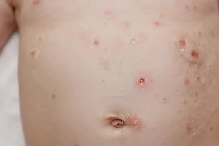 嬰兒肚子上出濕疹可不可以自愈(圖2)