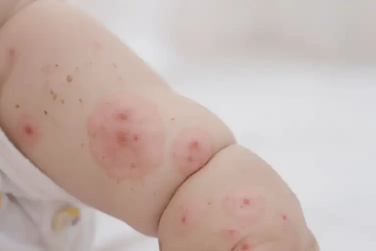 幼兒全身容易起濕疹可不可以徹底自愈(圖3)