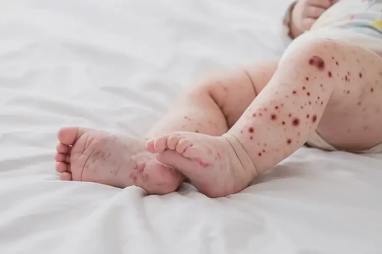 寶寶大腿經常長濕疹能不能自愈(圖4)