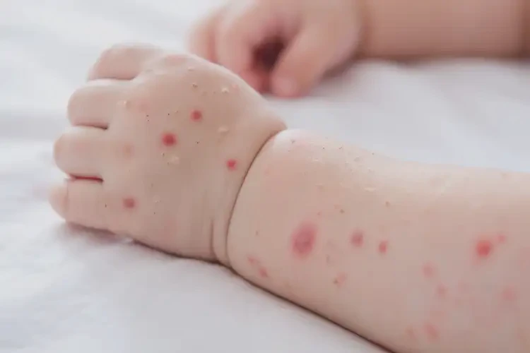 寶寶手臂上有濕疹能夠治愈嗎(圖4)