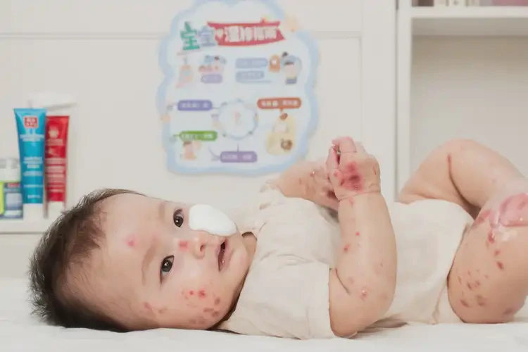 嬰幼兒四肢偶爾長(zhǎng)濕疹不管它會(huì)自己自愈嗎(圖3)