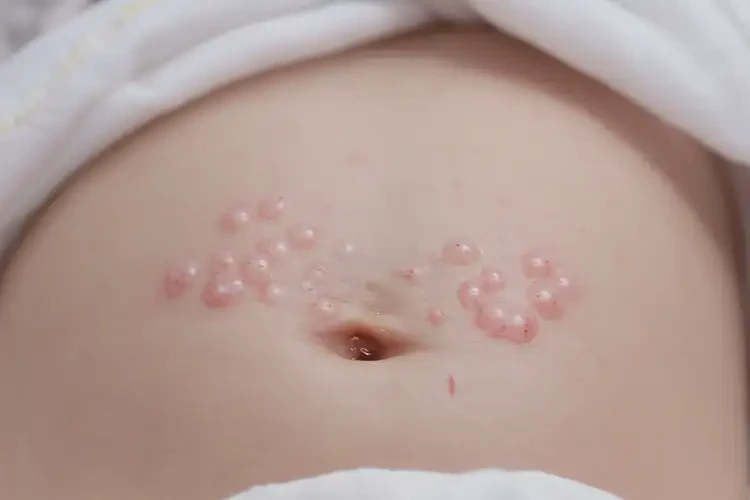 新生儿肚子长湿疹能够彻底治愈吗(图4)