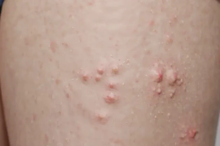 女生大腿長(zhǎng)濕疹可不可以徹底自愈(圖4)