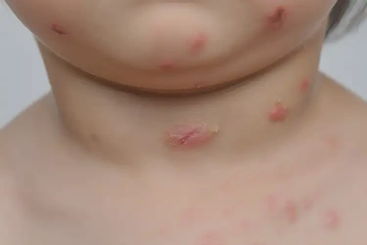小兒脖子上容易長濕疹能靠自己自愈嗎(圖4)