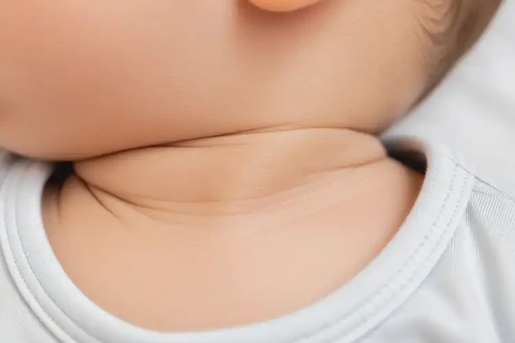 嬰幼兒脖子上容易長濕疹能靠自己自愈嗎(圖2)