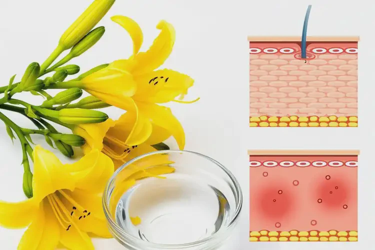 玫瑰痤瘡可以吃黃花菜嗎(圖4)