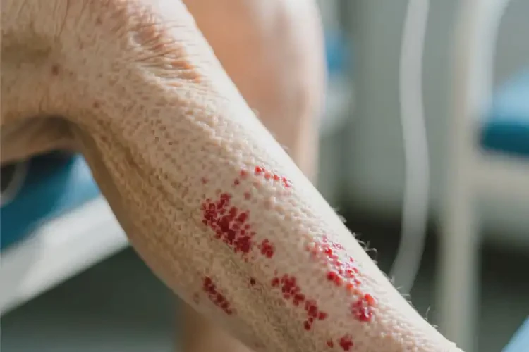 老年人小腿上容易起濕疹不管它會自己好嗎(圖4)