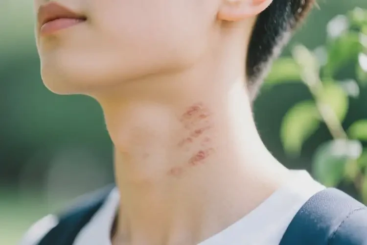 大学生脖子上出湿疹能自愈吗(图4)