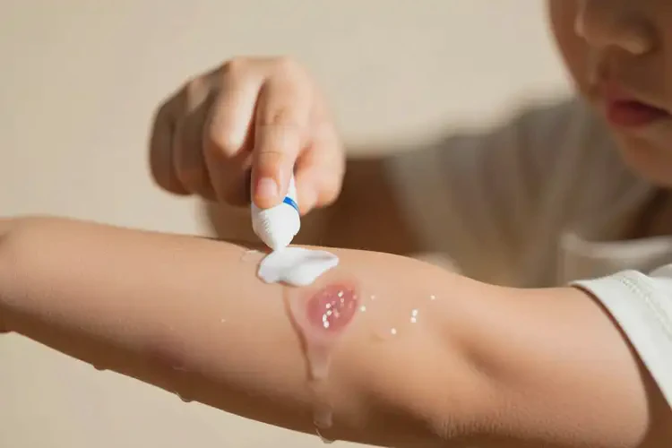 孩子手臂上的濕疹怎么治療(圖3)