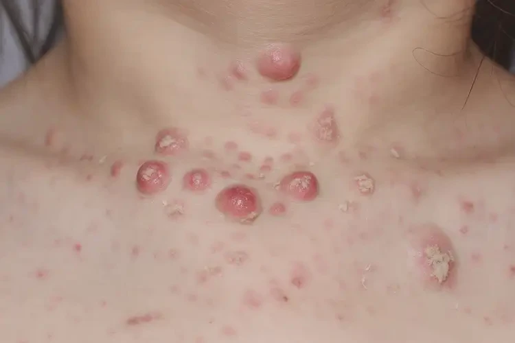 少兒脖子經(jīng)常長(zhǎng)濕疹可不可以徹底自愈(圖4)