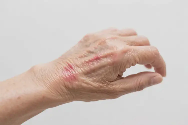 老年人身上偶尔长湿疹可不可以自愈(图2)