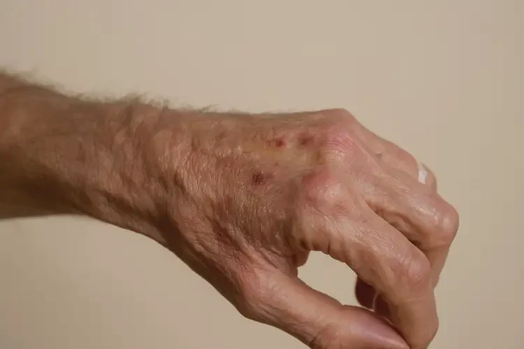 老年人手上出濕疹可不可以徹底自愈(圖3)