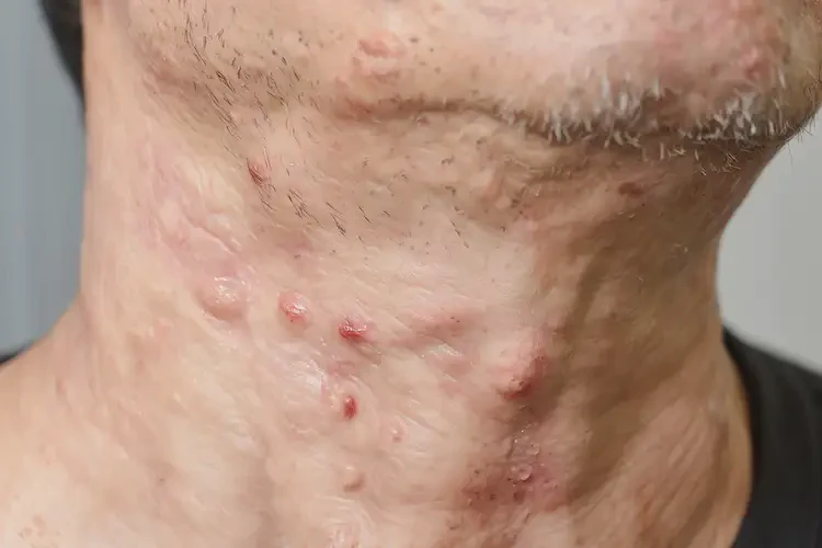 男性脖子出濕疹能靠自己自愈嗎(圖4)