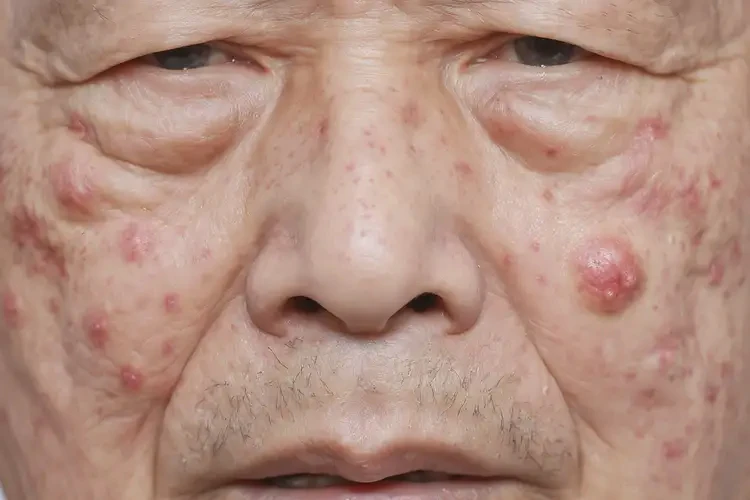 老人屁股上容易長濕疹能夠徹底治愈嗎(圖4)