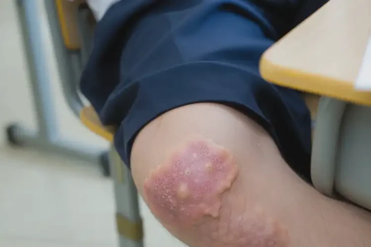 中學生大腿上經常起濕疹不管它會自己痊愈嗎(圖4)