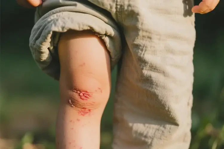 小孩大腿偶爾長濕疹不管它會自己自愈嗎(圖1)