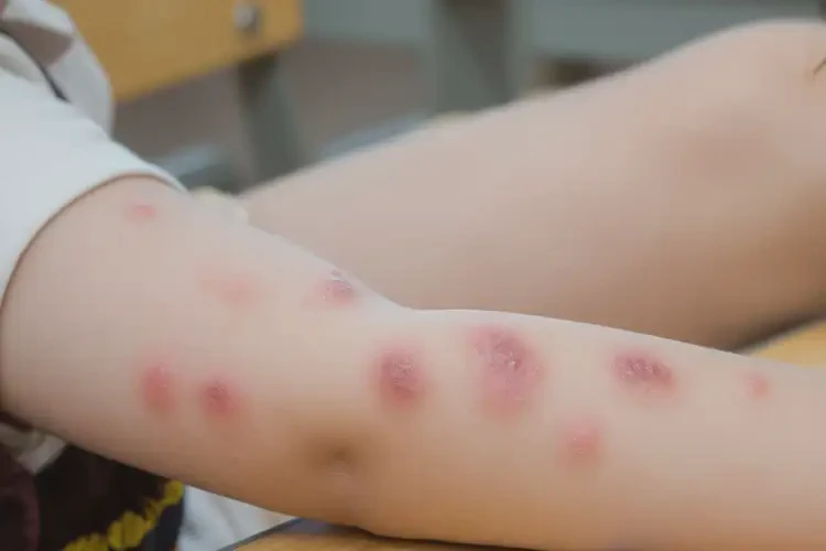 小學(xué)生手臂上出濕疹可以徹底自愈嗎(圖4)