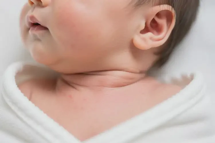 嬰幼兒脖子上容易長濕疹能靠自己自愈嗎(圖4)