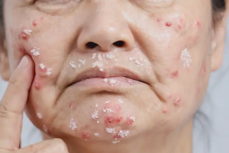 大學(xué)生面部起濕疹不管它會自己痊愈嗎(圖4)