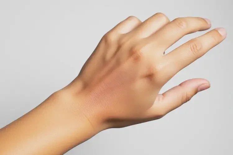 青少年手臂容易起濕疹可以自愈嗎(圖2)