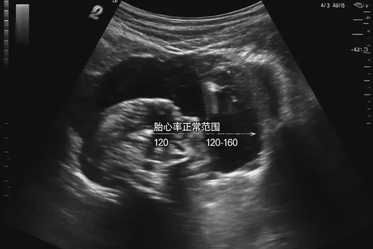 孕5周1天胎心率181還能保住嗎(圖4)