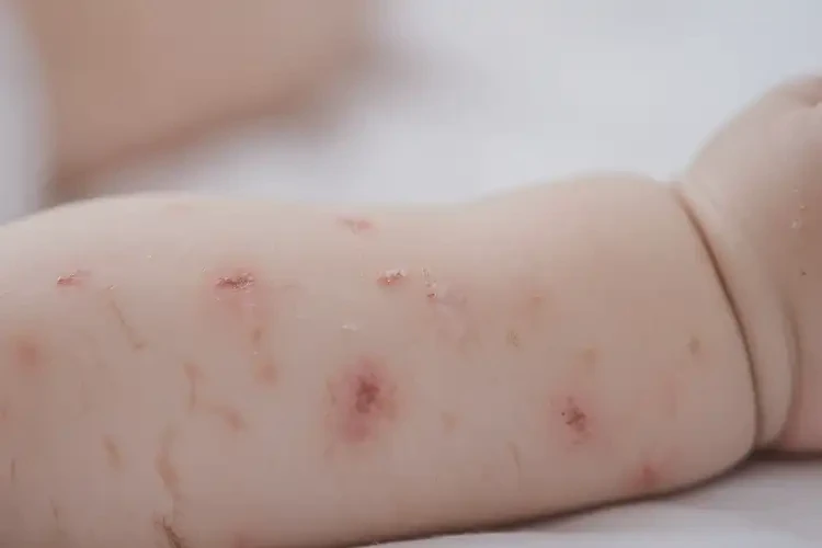 幼兒手臂容易長濕疹不管它會自己好嗎(圖4)