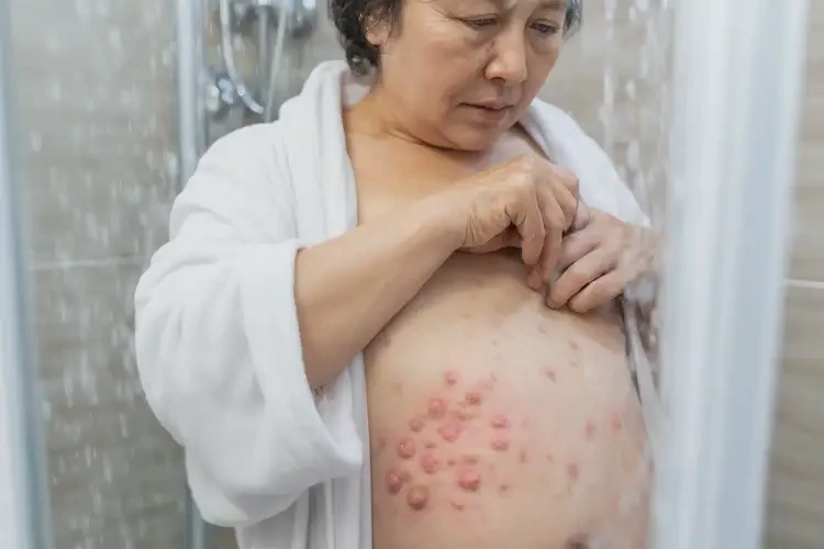 女人肚子上偶爾長濕疹不管它會自己自愈嗎(圖2)