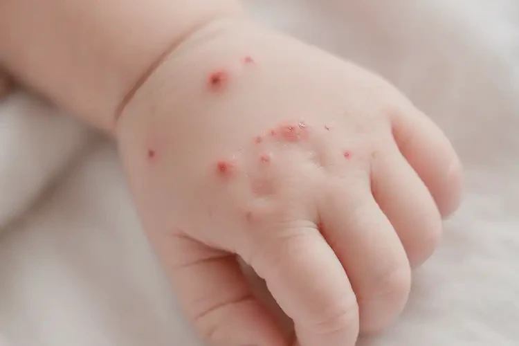 新生兒手上偶爾長濕疹能徹底自愈嗎(圖4)