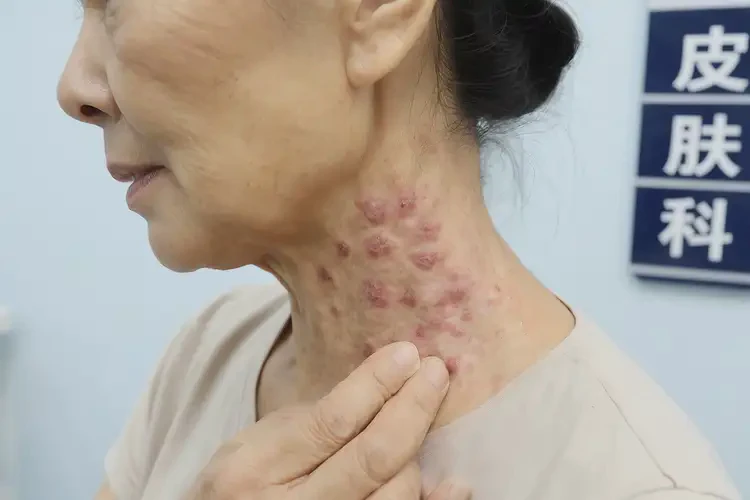 女生脖子容易起湿疹不管它会自己自愈吗(图4)