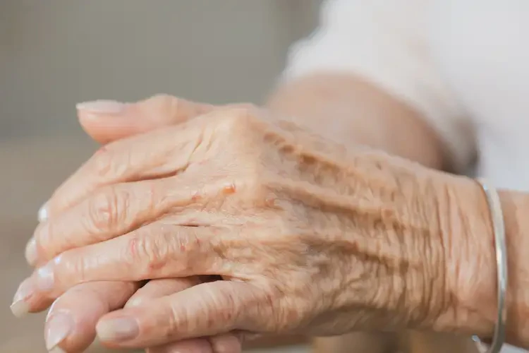 老年人手上經(jīng)常起濕疹怎么算是痊愈(圖4)