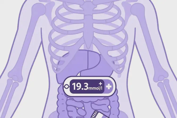 青少年晚上血糖19點(diǎn)3是糖尿病嗎(圖1)