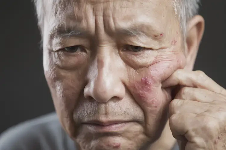 老年人臉上偶爾起濕疹能不能徹底自愈(圖4)