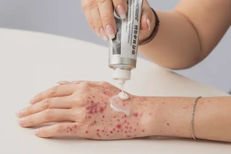 女人手上出現(xiàn)濕疹可不可以徹底自愈(圖3)