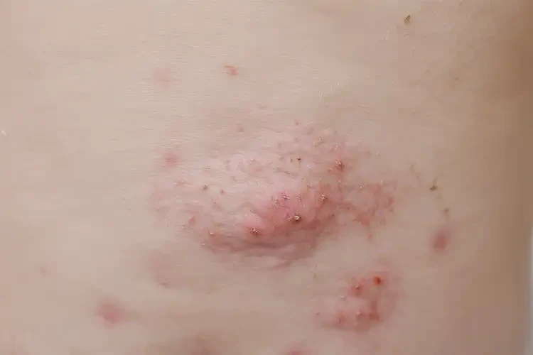 幼兒肛周偶爾長(zhǎng)濕疹會(huì)自己好嗎(圖4)