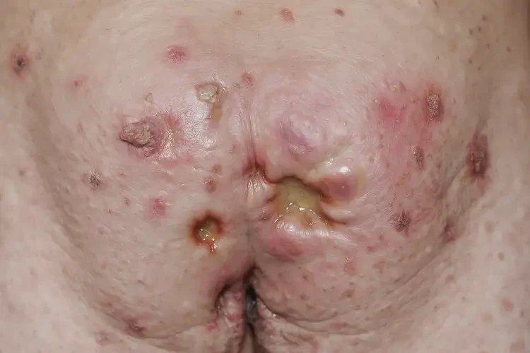 男性肛周出濕疹能自愈嗎(圖4)