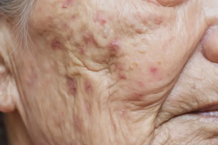 高齡老人脖子容易長濕疹可以徹底自愈嗎(圖4)