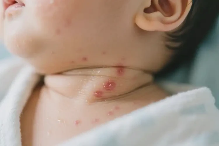 嬰幼兒脖子上容易長濕疹能靠自己自愈嗎(圖1)