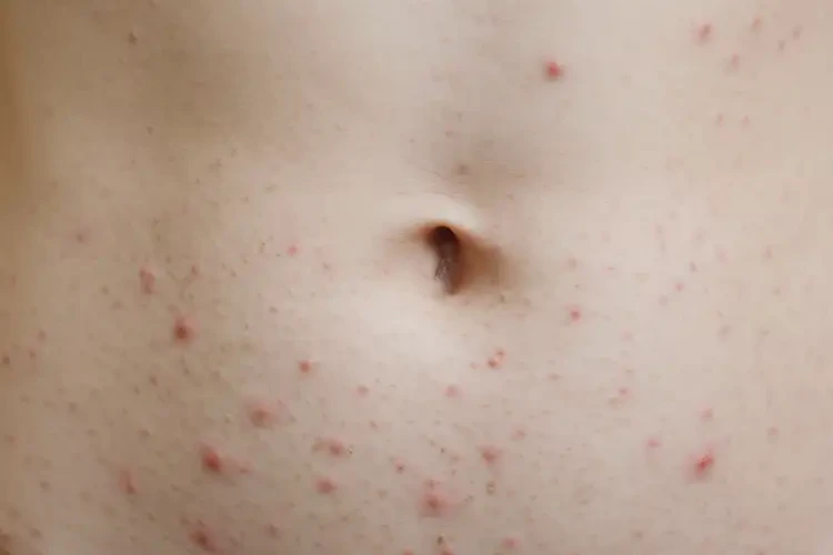 青少年肚子有濕疹可不可以徹底自愈(圖4)