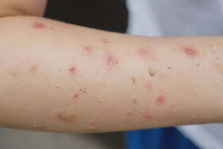 中學生手臂上有濕疹能夠徹底治愈嗎(圖4)